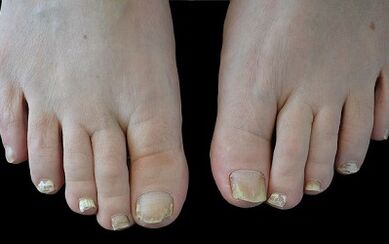 kako se znebiti glive na prstih