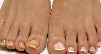 Metode zdravljenja gliv flote