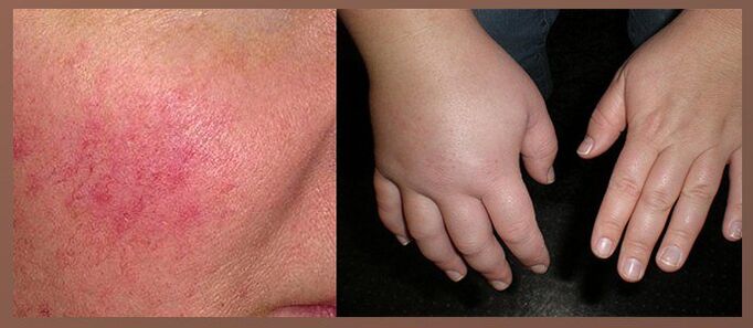 Neželeni učinki kapljic